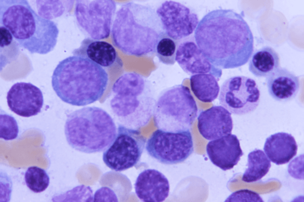 White blood cells in patient with acute leukemia