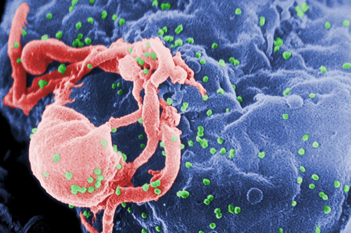 HIV infecting a lymphocyte